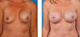 Breast Correction Before and After bakersfield